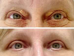 Traitement Du Xanthelasma Au Laser Dr Abidi