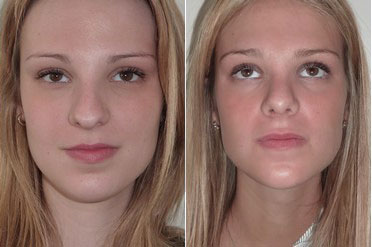 rhinoplastie nez large