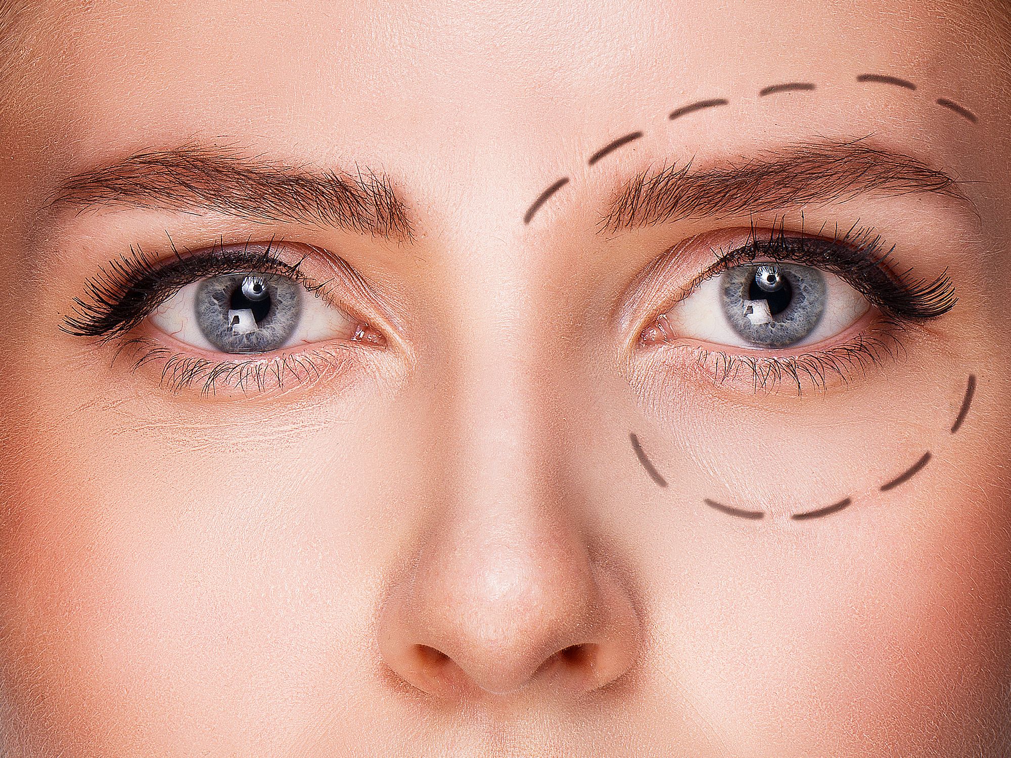 blepharoplastie