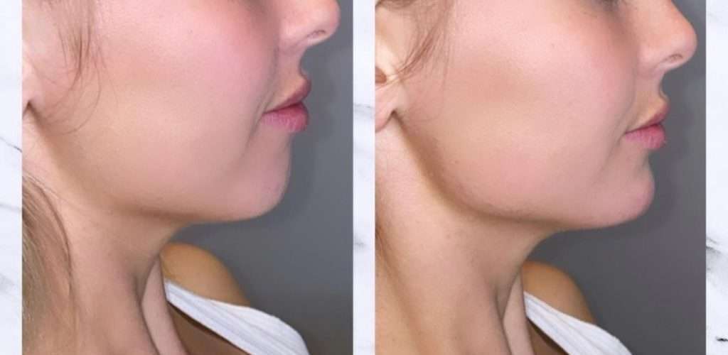 jawline contouring fillers