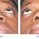 Rhinoplastie sur Peau Épaisse