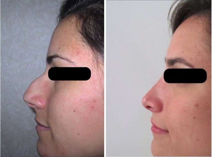 chirurgie combinee front rhinoplastie