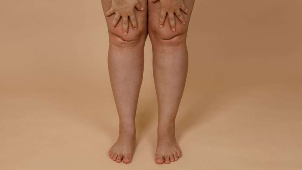 chirurgie esthetique liposuccion genoux tunisie