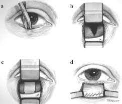 chirurgie esthetique fracture plancher orbital