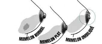 chirurgie esthetique mamelon ombiliqué tunisie