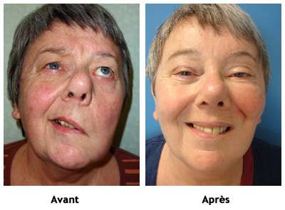 chirurgie esthetique sourire paralysé avant apres