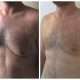 chirurgie esthetique tunisie pour gynecomastie unilateral avant apres