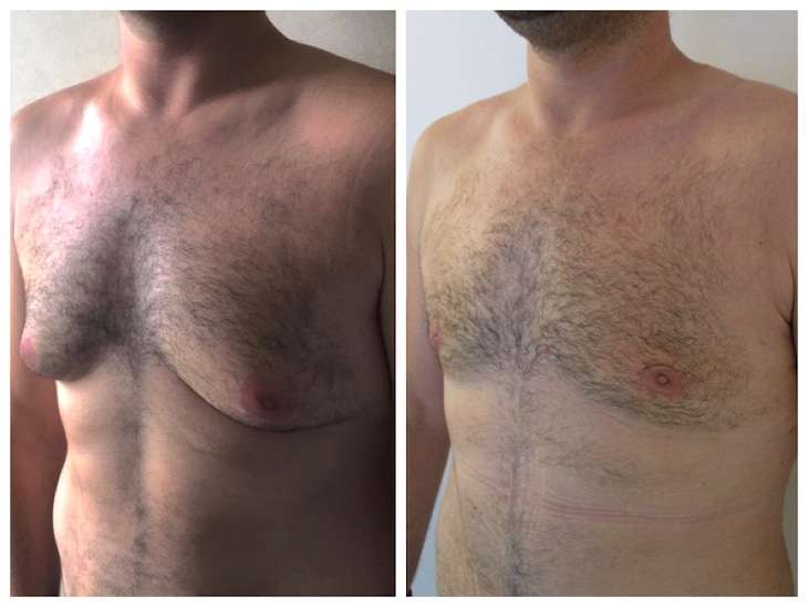 chirurgie esthetique tunisie pour gynecomastie unilateral avant apres