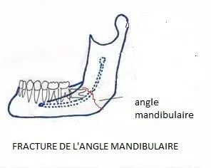 chirurgie fracture mandibulaire