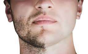 greffe barbe tunisie