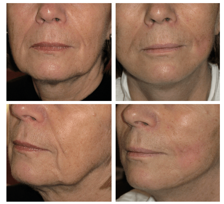 lifting facial bajoues