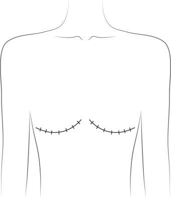 mastectomie de transgenres
