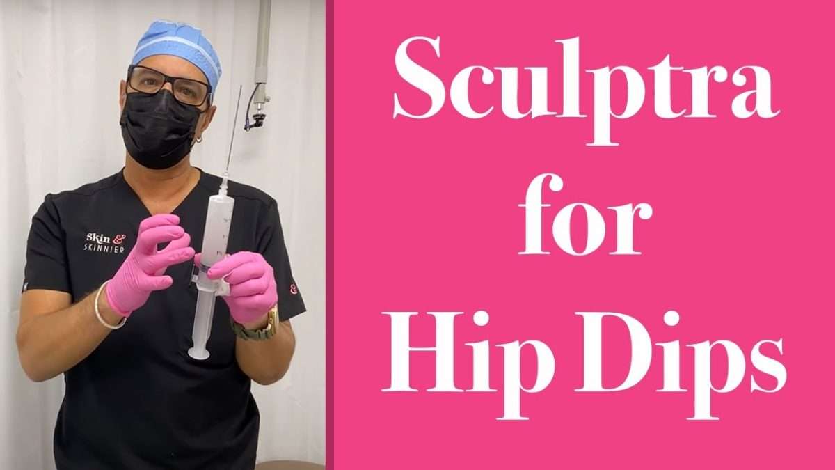 sculptra hip dips