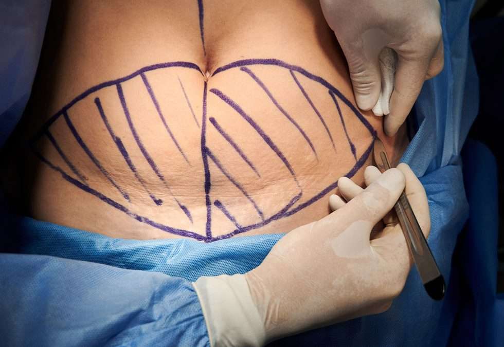 Abdominoplastie 15 jours après