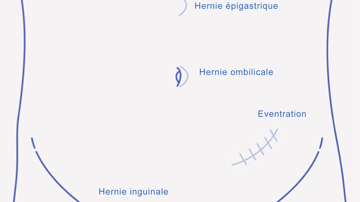 Chirurgie hernie ombilicale ligne blanche