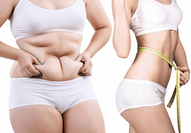 Vaser 3 Zones + abdominoplastie