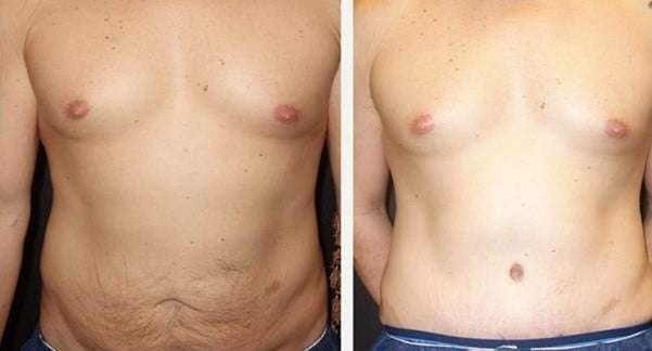 abdominoplastie apres 10 ans avant apres