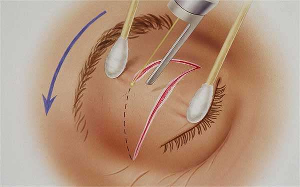 chirurgie des paupieres au laser