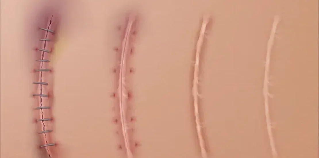 cicatrice abdominoplastie 1 an apres
