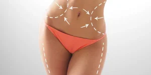 liposuccion 1 zone ou 2 zones + abdominoplastie