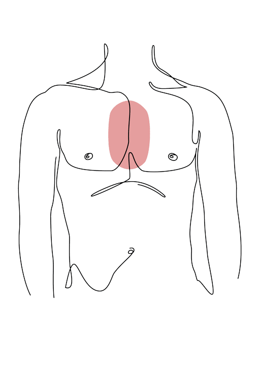 syndrome de poland chirurgie