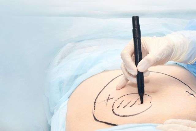 Liposuccion et abdominoplastie en même temps