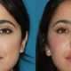 Rhinoplastie ultrasonique prix Montréal