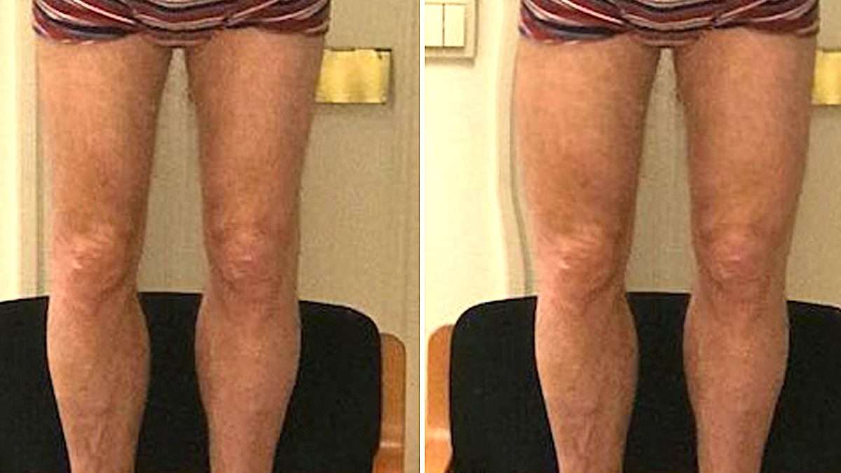 Quadriceps augmentation par implants