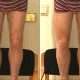 Quadriceps augmentation par implants