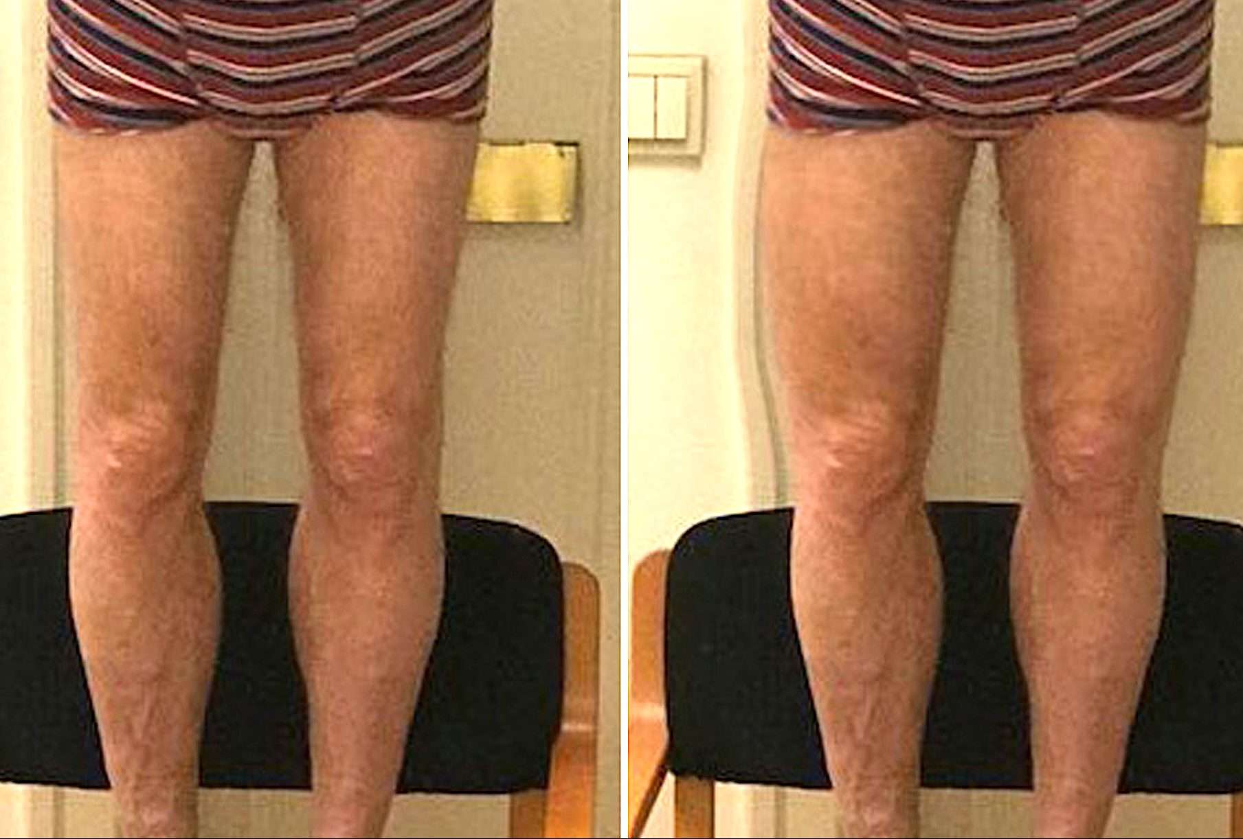 Quadriceps augmentation par implants