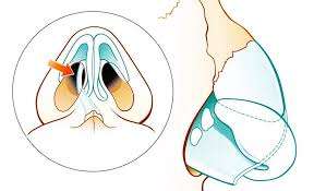 Septoplastie avec greffe de cartilage