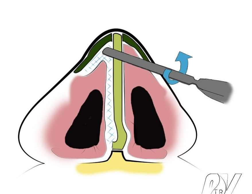 allongement nez avec cartilage