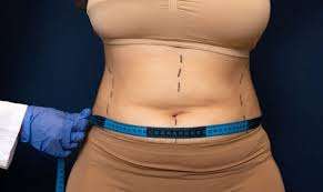 mini abdominoplastie chirurgie robotique