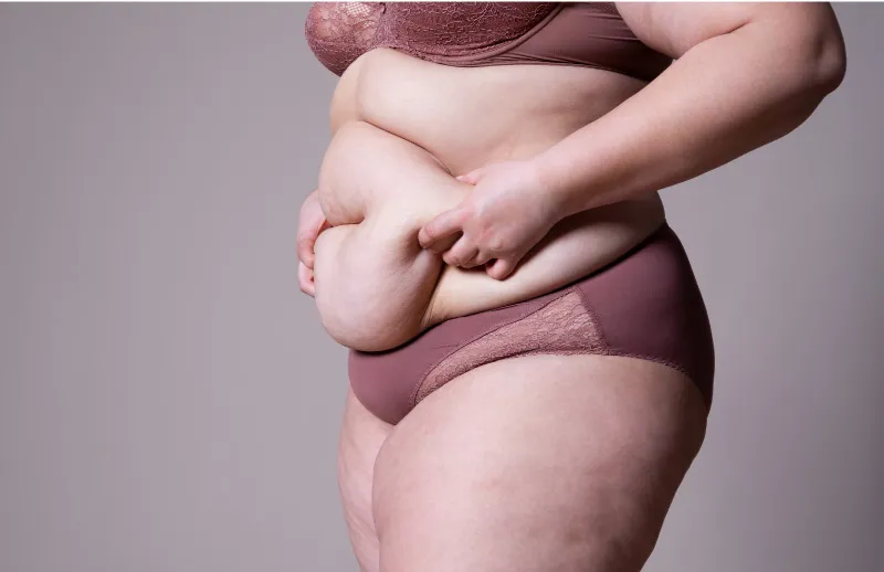 deuxième abdominoplastie