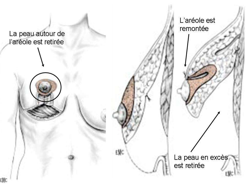 implant mammaire vs lifting