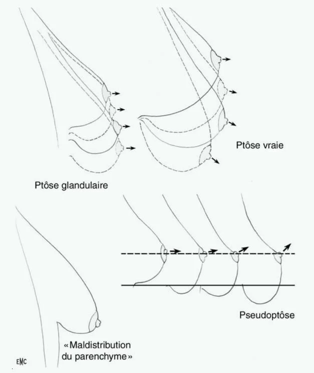 ptose mammaire qui necessite un lifting