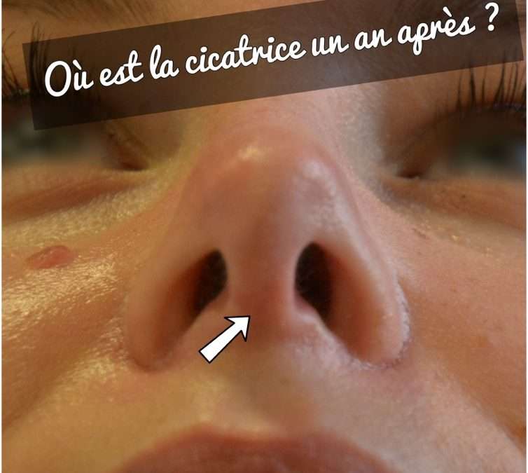 rhinoplastie cicatrice voie ouverte