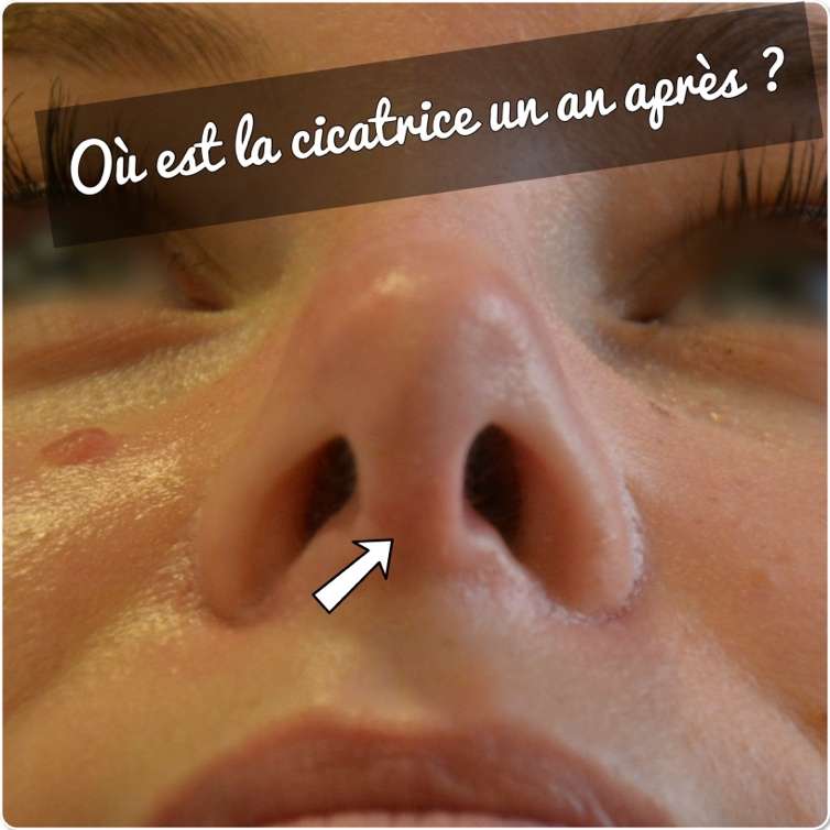 rhinoplastie cicatrice voie ouverte