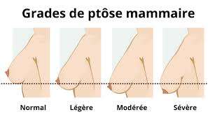 correction ptose mammaire ratee