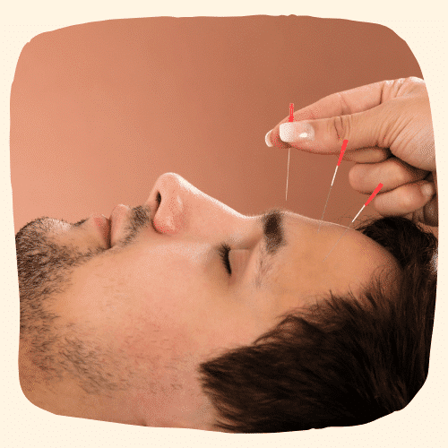 acupuncture traiter paralysie sourcil